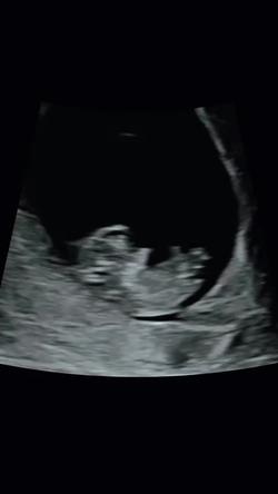 Recut | Pregnancy template