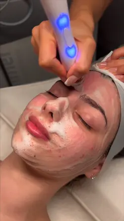 Microneedling aesthe