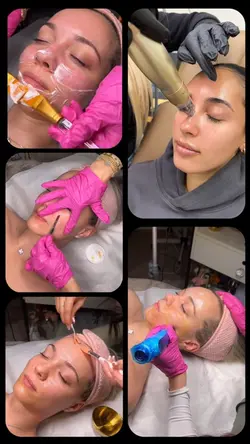 Microneedling