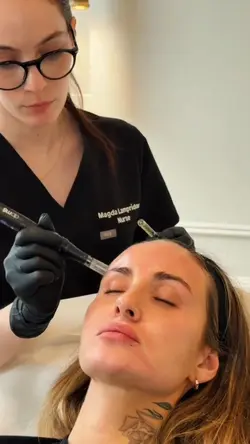 Microneedling