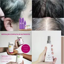 Tratamento Alopecia 