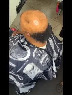 Alopecia 