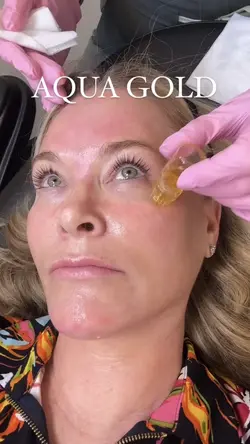 Microneedling