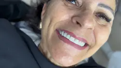Antes depois 