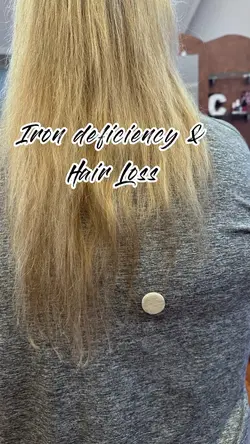 Hair loss 