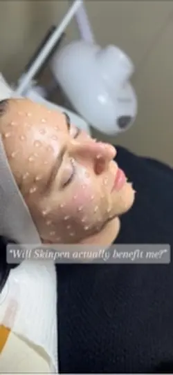 Skinpen