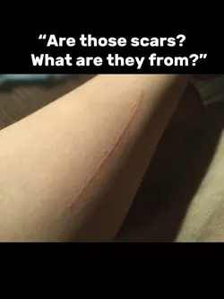 Dermatographia 😔