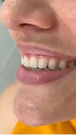 Antes e depois 