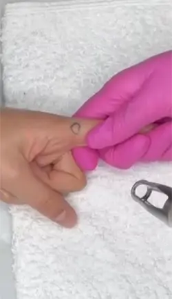 Tattoo Removal