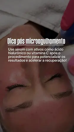 Microagulhamento 
