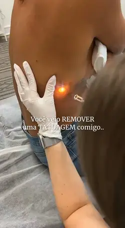 Remoção a laser 