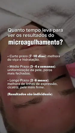 Microagulhamento