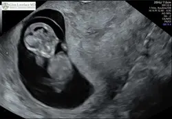 Ultrasound templat