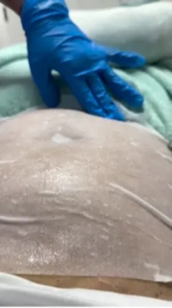 Criolipolisis 
