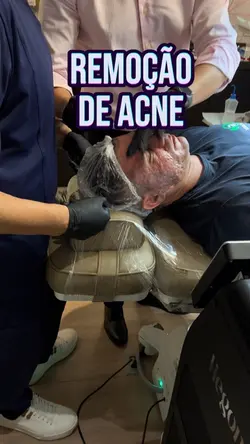 Remoção de acne 