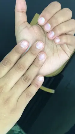 Antes e depois