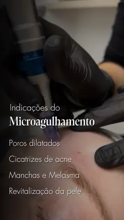 Microagulhamento