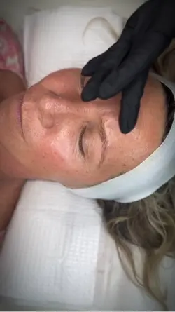 Microneedling 