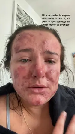 acne solution review
