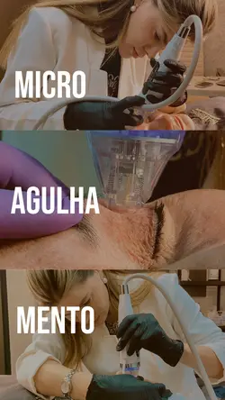 MICROAGULHAMENTO