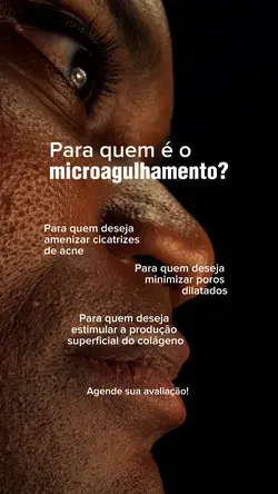 Estética microagulh