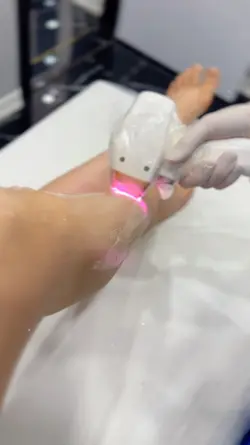 Lazer Epilasyon