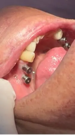 Implante dental