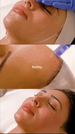 Microneedling aesthe
