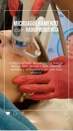 MICROAGULHAMENTO