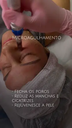 Microagulhamento