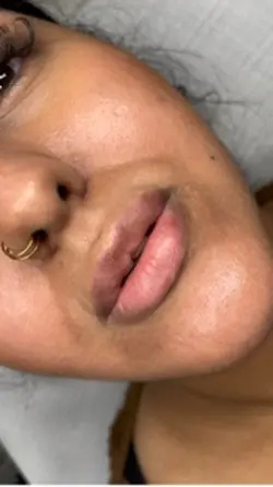 Lip filler London