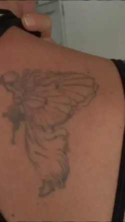 Laser Tattoo Remova