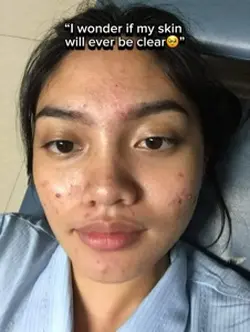 ACNE TRANSFORMATION