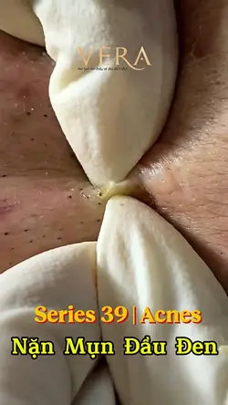 Series 39 | Acnes