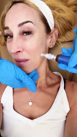 Microneedling aesthe