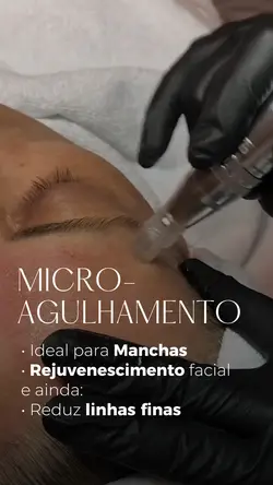 Microagulhamento