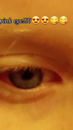 pink eye