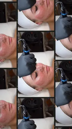 Microneedling aesthe