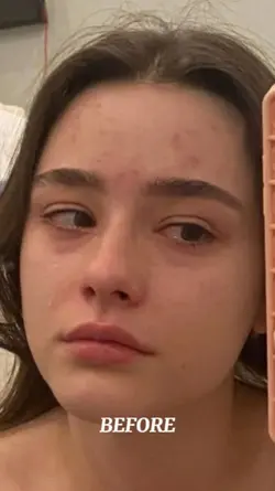 Before x after glow