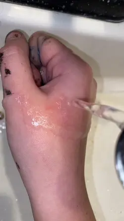 I burnt mysel