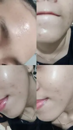 acne story 