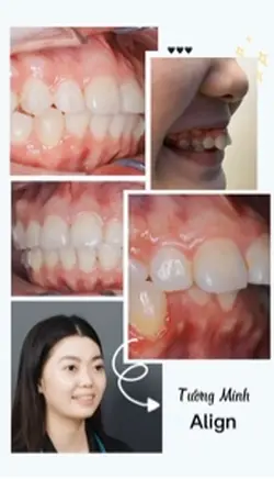 Răng xinh