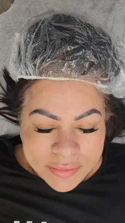 Post Eyebrow removal