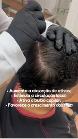 Microagulhamento