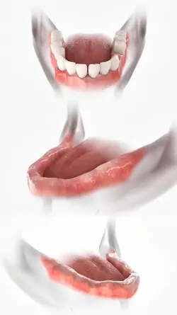 implante dentário 