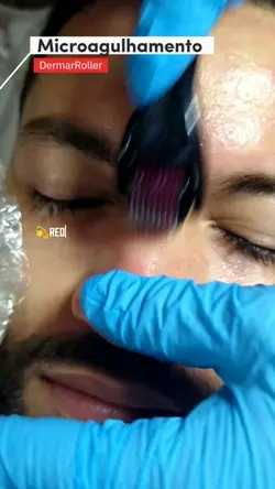Microagulhamento 