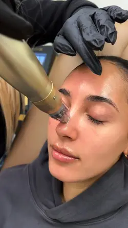 Microneedling aesthe