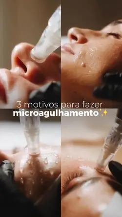 Microagulhamento