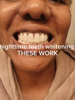 Teeth whitening 