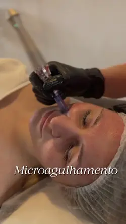 Microagulhamento